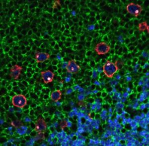 Quantum Dots in Hodgkin's Lymphoma